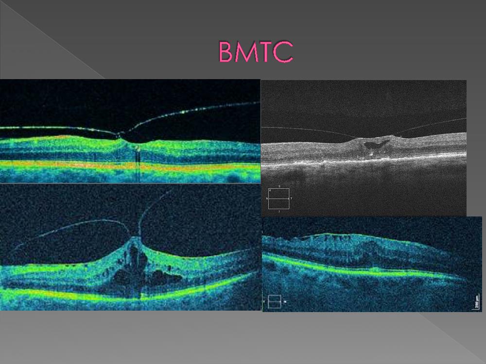 Окт. Макулярный тракционный синдром. Тракционный макулярный синдром глаза. Витреомакулярный тракционный синдром глаза. Витторио макулярный тракционный синдром.