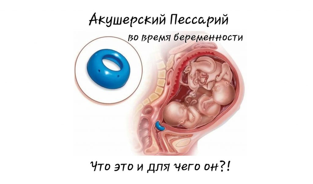 Пессарий для чего