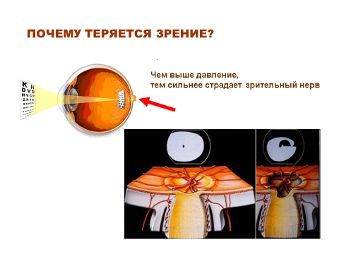 ГЛАУКОМА - ОСНОВНАЯ ПРИЧИНА СЛЕПОТЫ В МИРЕ